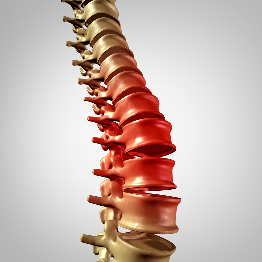 Spine pain and lower back disease and human backache with a three dimensional spinal body skeleton showing the vertebra and vertebral column in glowing red highlight as a medical health care concept for joint pain.